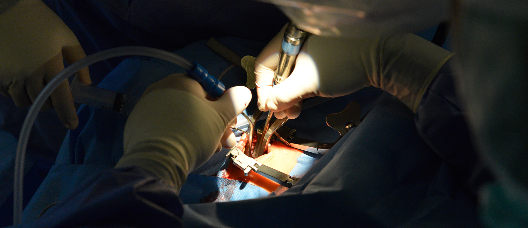 Hände eines Operateurs der Abteilung für Neurochirurgie während einer Wirbelsäulenoperation 